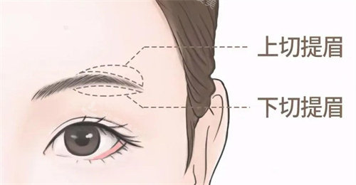 提眉手术不同切口 提眉手术不同切口