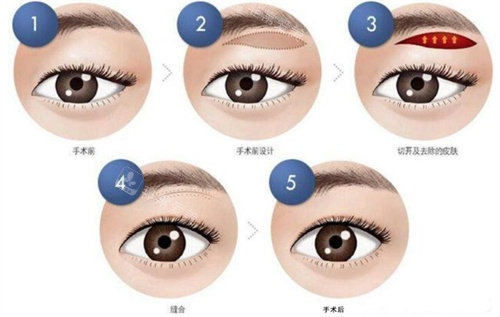 提眉手术怎么做的 提眉手术怎么做的