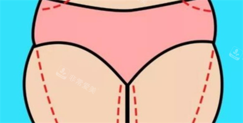 大腿吸脂术前画线展示图
