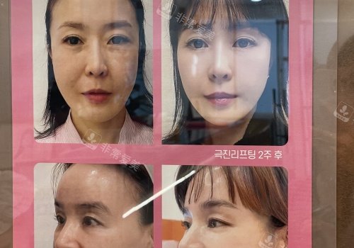 韩国pangpang医院对比照