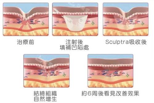 注射童颜针后皮肤的变化周期