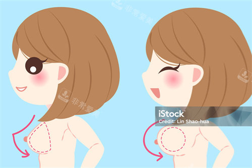 隆胸手术对比展示