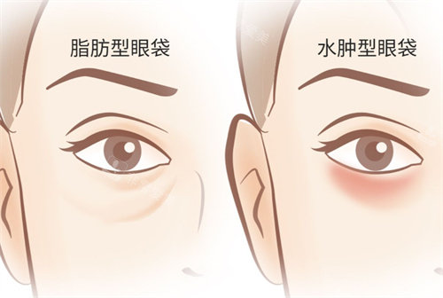 眼袋类型卡通图、