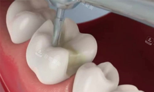嵌体补牙过程