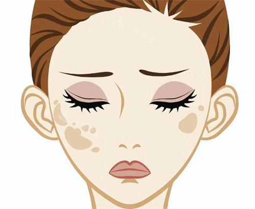 祛斑治疗卡通图片