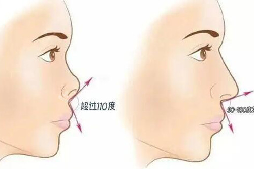 朝天鼻正常鼻子夹角对比