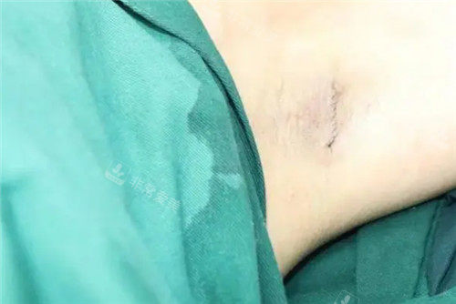 腋臭手術(shù)疤痕圖
