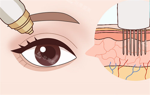 眼部黄金微针卡通图