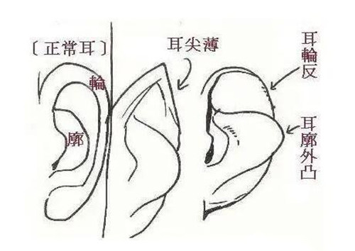 反骨耳矫正改善