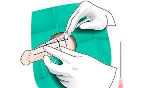 海绵体注射动画演示图