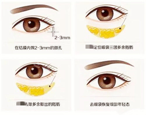 去眼袋过程图示