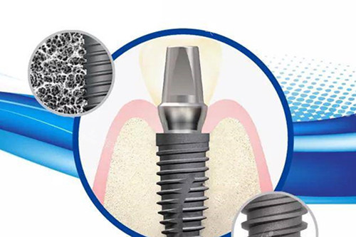 仕诺康种植牙示意图
