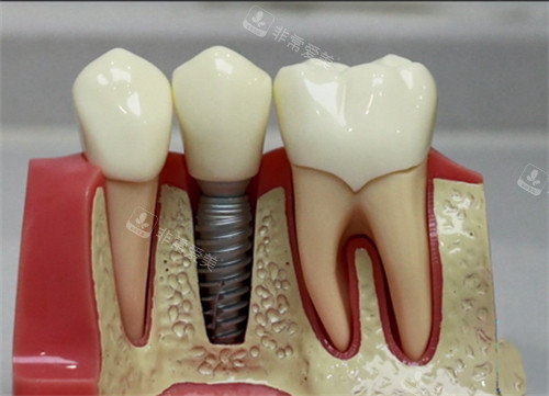 种植牙模型实物展示图