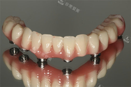 全口种植牙下颌
