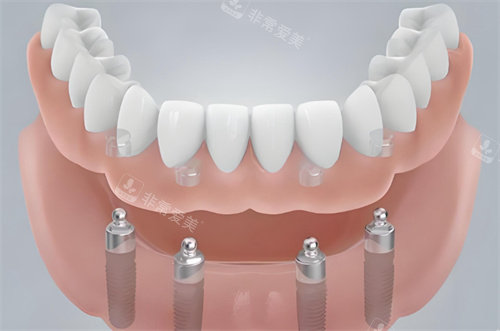 半口种植牙模型图展示