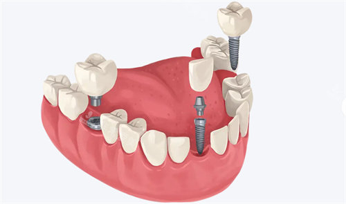种植牙动画展示
