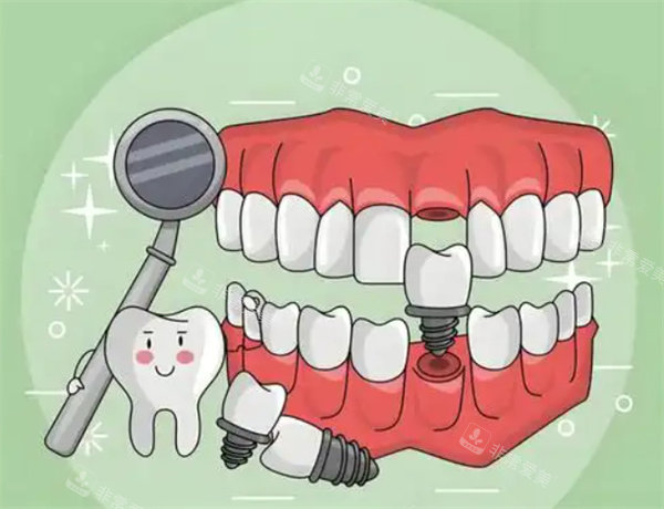 种植牙齿图片