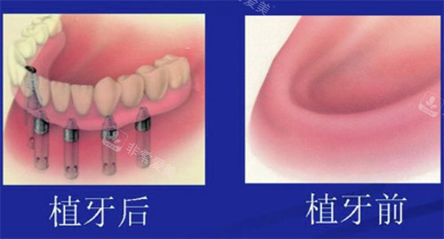 全口种植牙前后