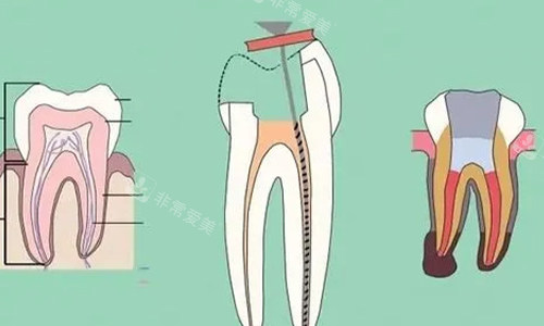 根管治疗的步骤示意