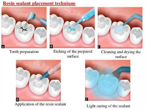 窝沟封闭流程图