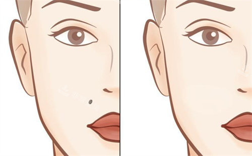 祛痣前后卡通对比图