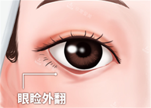 下睑外翻症状