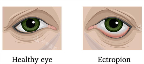 下睑外翻是什么