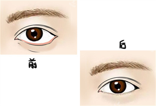 下睑外翻手术前后