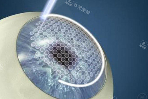 全飞秒近视手术示意图