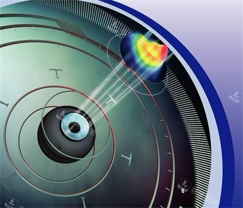 个性化微飞秒手术前角膜地图导航检测过程图