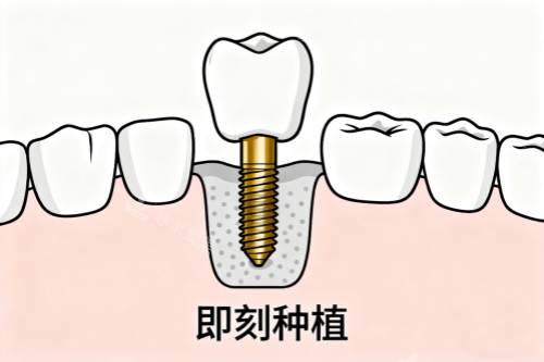 牙齿即刻种植卡通图