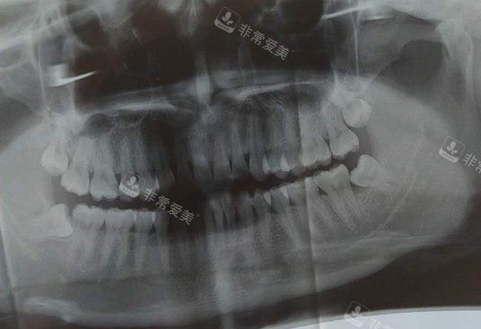 口腔牙齿ct照片