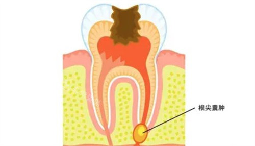 什么是根尖囊肿