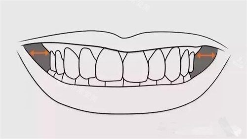 牙齿矫正扩牙弓颊廊