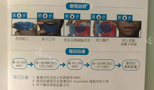 牙齿矫正MRC早期肌功能矫正说明