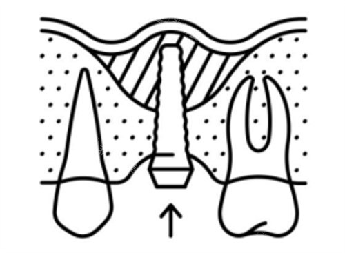 上颌窦种植牙简笔图
