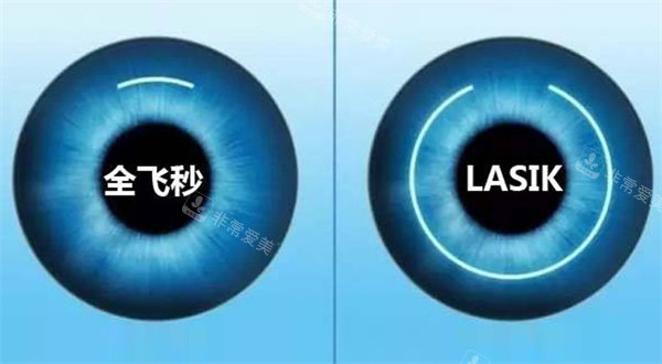 全飞秒激光近视眼手术