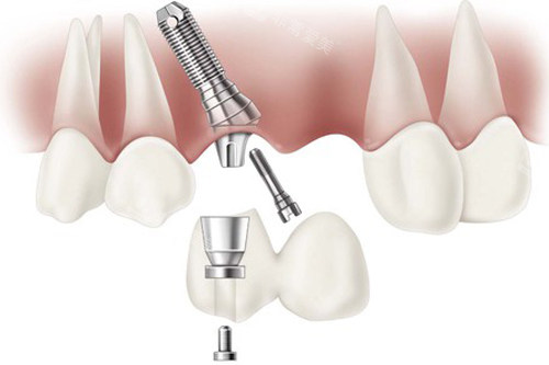 种植牙一拖二成效图