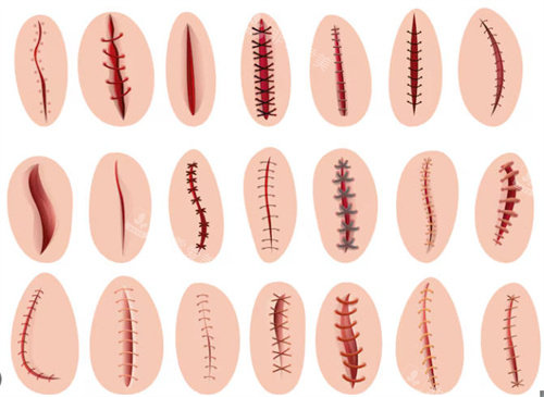 各种疤痕缝合口
