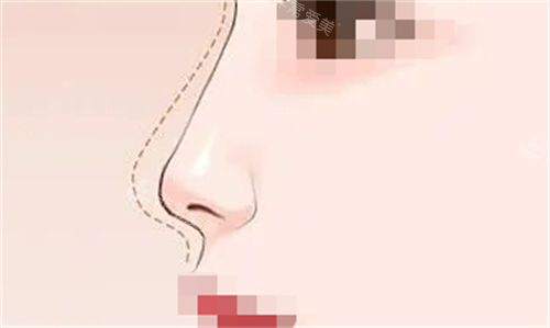 隆鼻預(yù)期弧度動(dòng)畫呈現(xiàn)圖