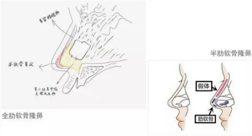 全肋和半肋隆鼻的區(qū)別圖解