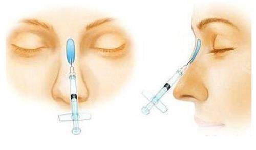 液態(tài)隆鼻示意圖