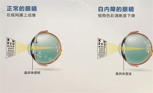 正常眼睛和白内障眼睛的对比图