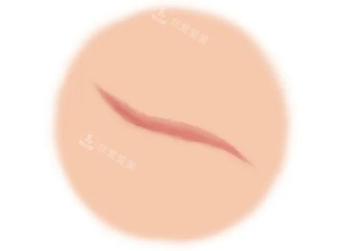 下颌角长曲线截骨的截骨位置