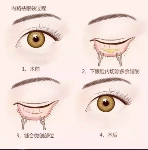 内路祛眼袋图示