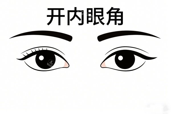 开内眼角卡通图展示