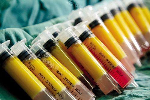 自体脂肪丰胸脂肪 自体脂肪丰胸脂肪