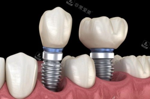 种植牙修复卡通一览