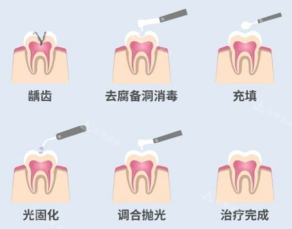 补牙步骤展示图
