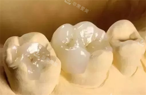 补牙模型展示图